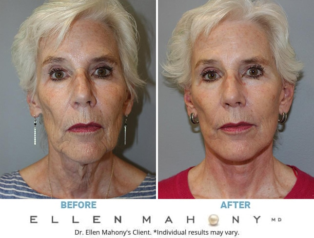 Before and After Image: Case #12700 - front