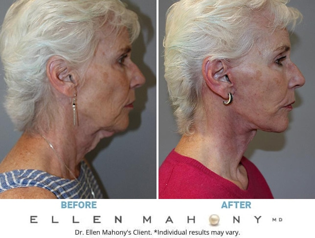 Before and After Image: Case #12700 - right-side