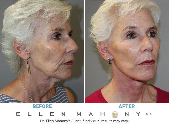 Before and After Image: Case #12700 - right-front-oblique