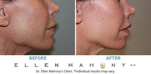 Before and After Image: Case #12850 - right-side