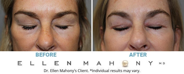 Before and After Image: Case #10050 - front