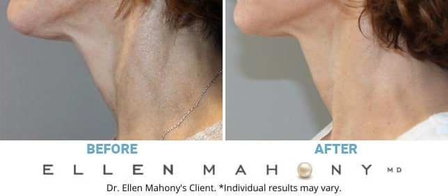Before and After Image: Case #12220 - left-side