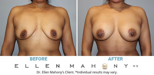 Before and After Image: Case #13045 - front