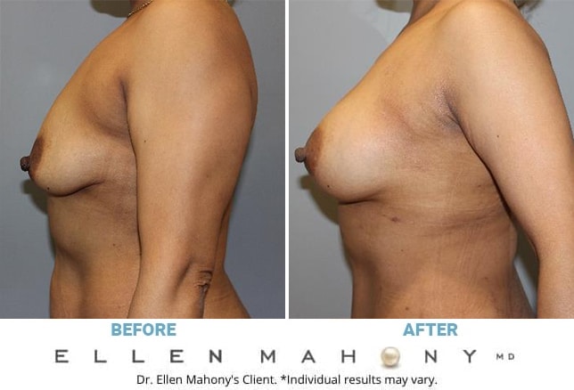 Before and After Image: Case #13045 - left-side