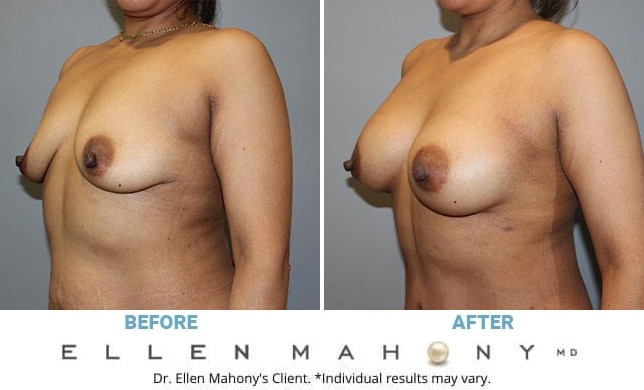Before and After Image: Case #13045 - left-front-oblique