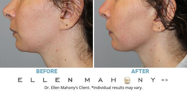 Before and After Image: Case #13073 - left-side