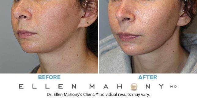 Before and After Image: Case #13073 - left-front-oblique