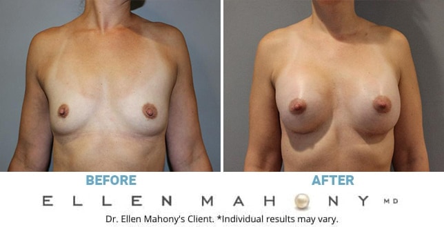 Before and After Image: Case #12840 - front