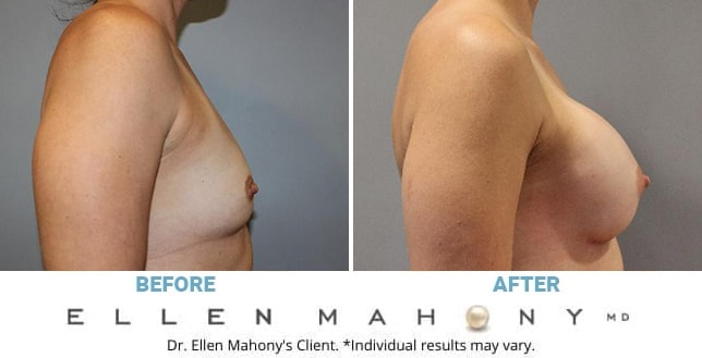 Before and After Image: Case #12840 - right-side