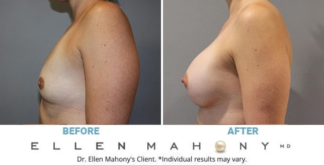 Before and After Image: Case #12840 - left-side