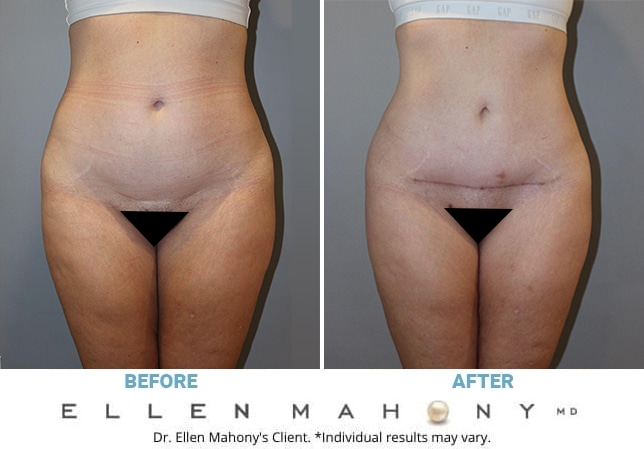 Before and After Image: Case #12963 - front