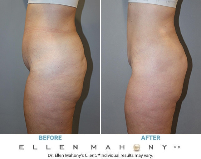 Before and After Image: Case #12963 - left-side