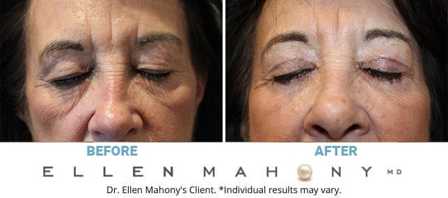 Before and After Image: Case #13132 - front