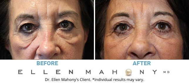 Before and After Image: Case #13132 - front