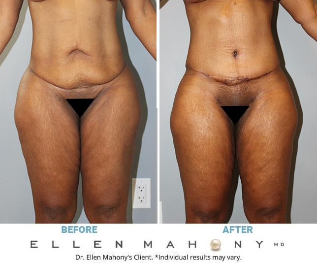 Before and After Image: Case #13064 - front