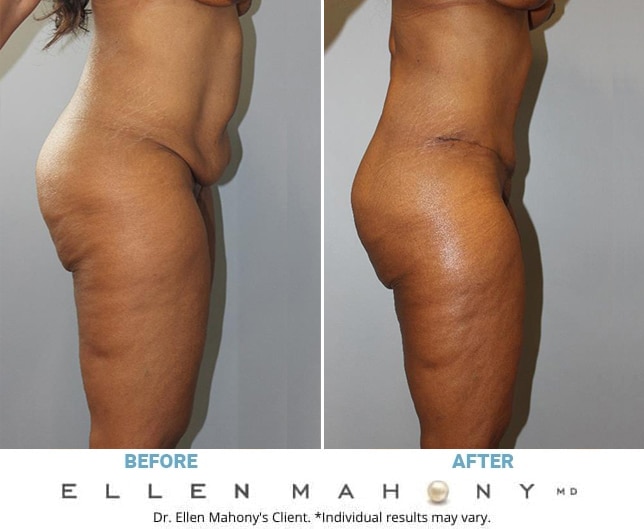 Before and After Image: Case #13064 - right-side