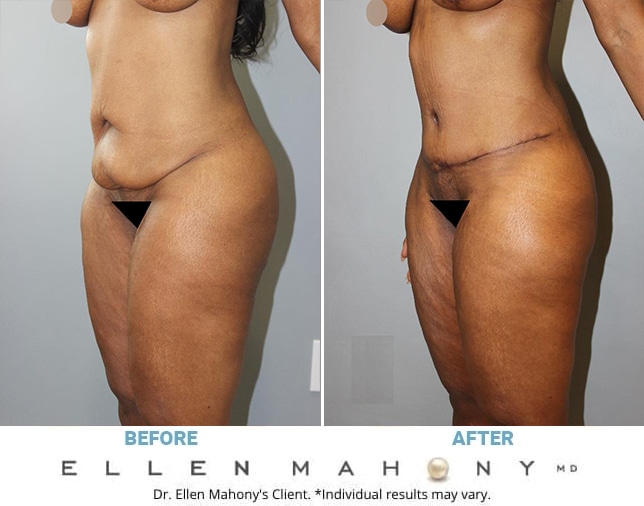Before and After Image: Case #13064 - left-front-oblique