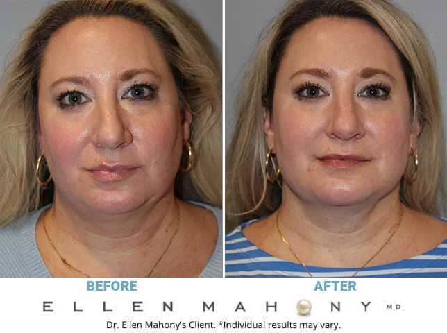 Before and After Image: Case #13094 - front