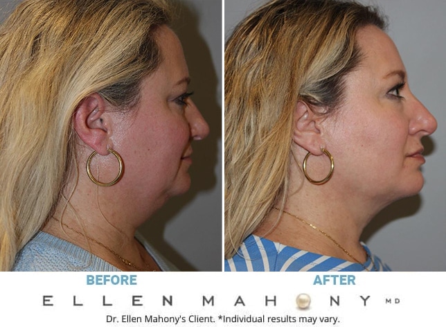 Before and After Image: Case #13094 - right-side