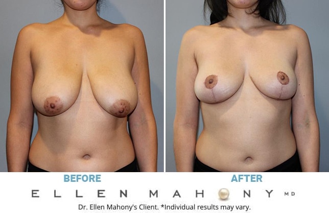 Before and After Image: Case #13194 - front