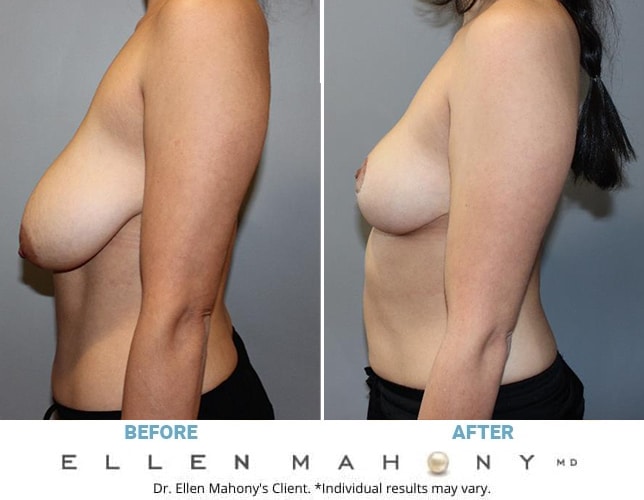 Before and After Image: Case #13194 - left-side