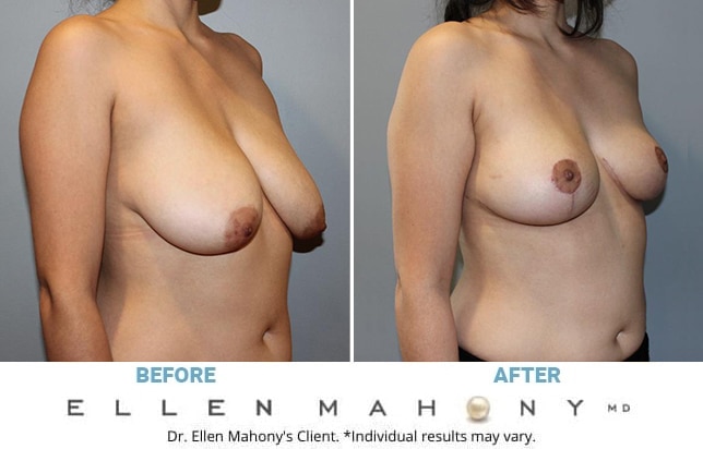 Before and After Image: Case #13194 - right-front-oblique
