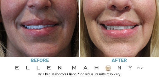 Before and After Image: Case #12218 - front
