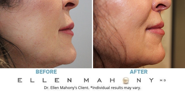 Before and After Image: Case #12470 - right-side