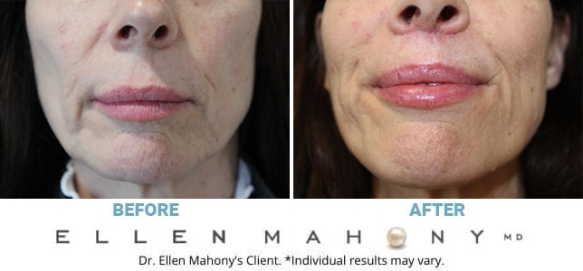 Before and After Image: Case #13397 - front