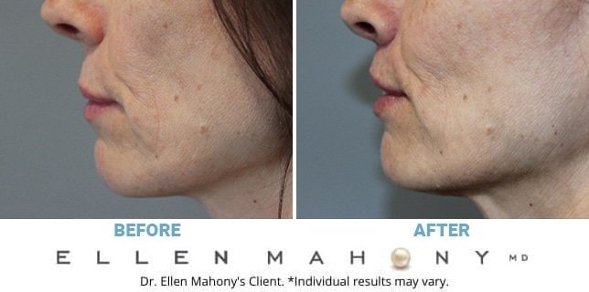 Before and After Image: Case #13397 - left-side
