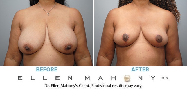 Before and After Image: Case #6105 - front