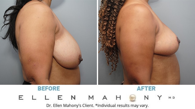 Before and After Image: Case #6105 - right-side