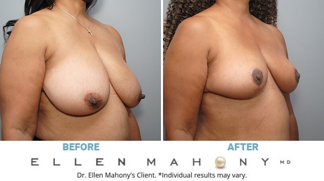 Before and After Image: Case #6105 - right-front-oblique