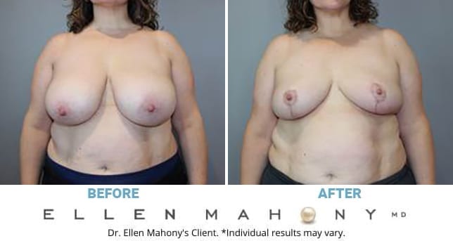 Before and After Image: Case #13277 - front
