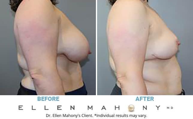 Before and After Image: Case #13277 - right-side