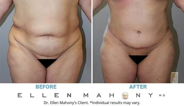 Before and After Image: Case #13396 - front