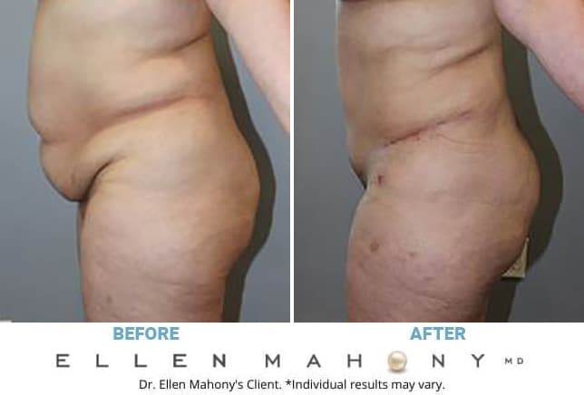 Before and After Image: Case #13396 - left-side