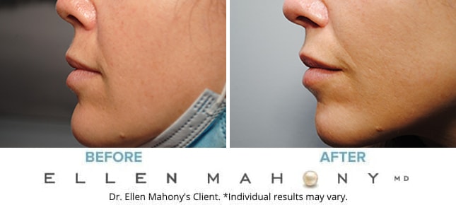 Before and After Image: Case #9145 - left-side