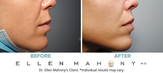 Before and After Image: Case #9145 - right-side