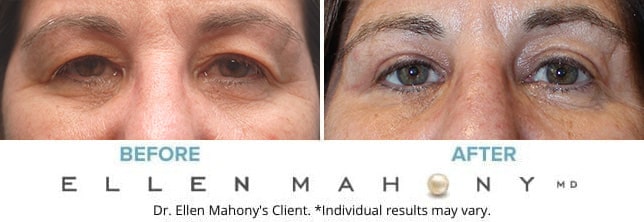 Before and After Image: Case #9901 - front