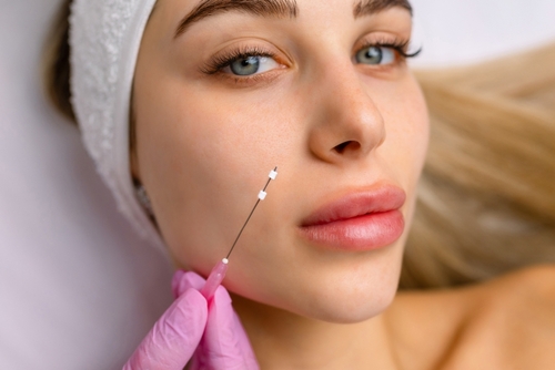 PDO Threadlift in Westport, CT