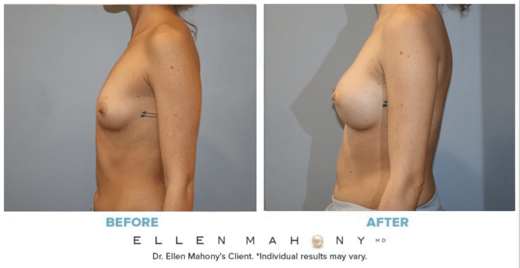 Before and After Image: Case #14945 - left-side