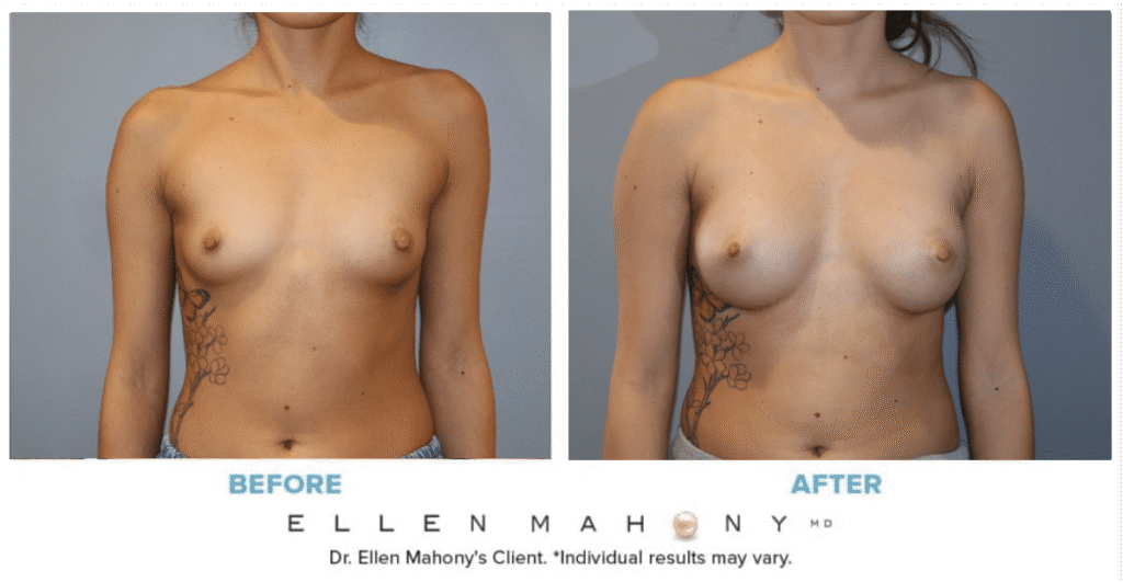 Before and After Image: Case #14945 - front
