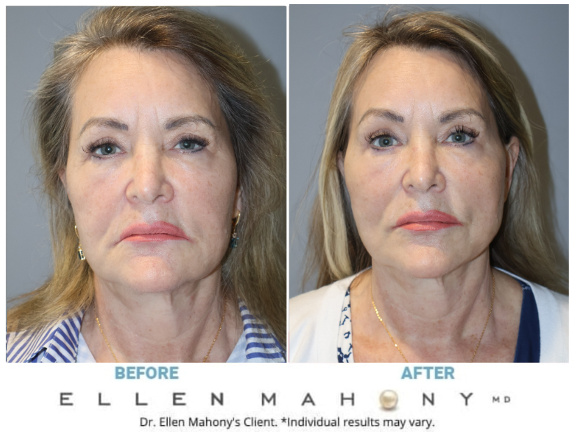 Before and After Image: Case #3919 - front