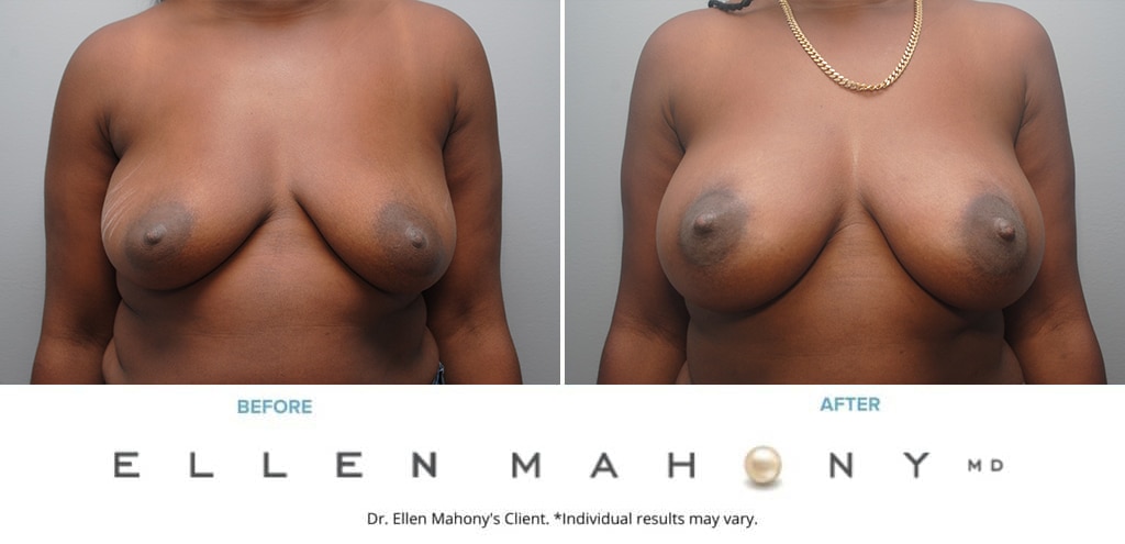 Before and After Image: Case #9937 - front