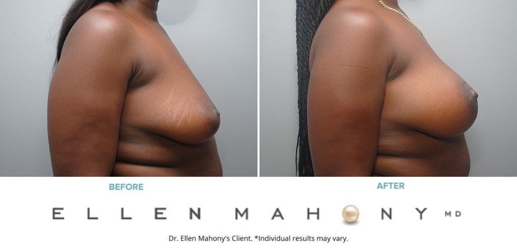 Before and After Image: Case #9937 - right-side