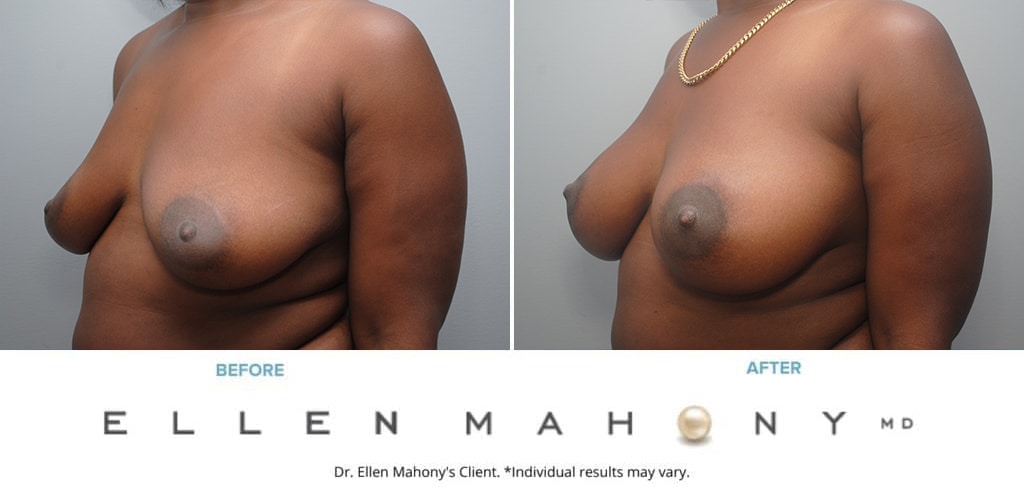 Before and After Image: Case #9937 - front