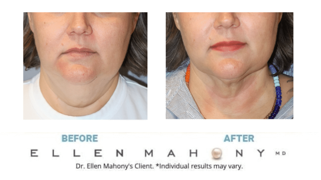 Before and After Image: Case #15237 - front