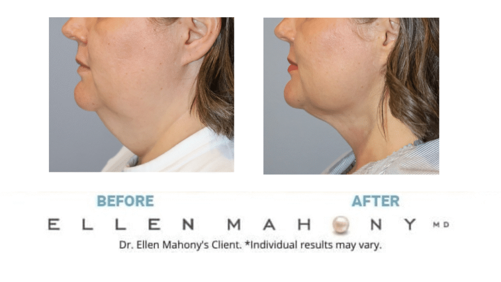 Before and After Image: Case #15237 - left-side