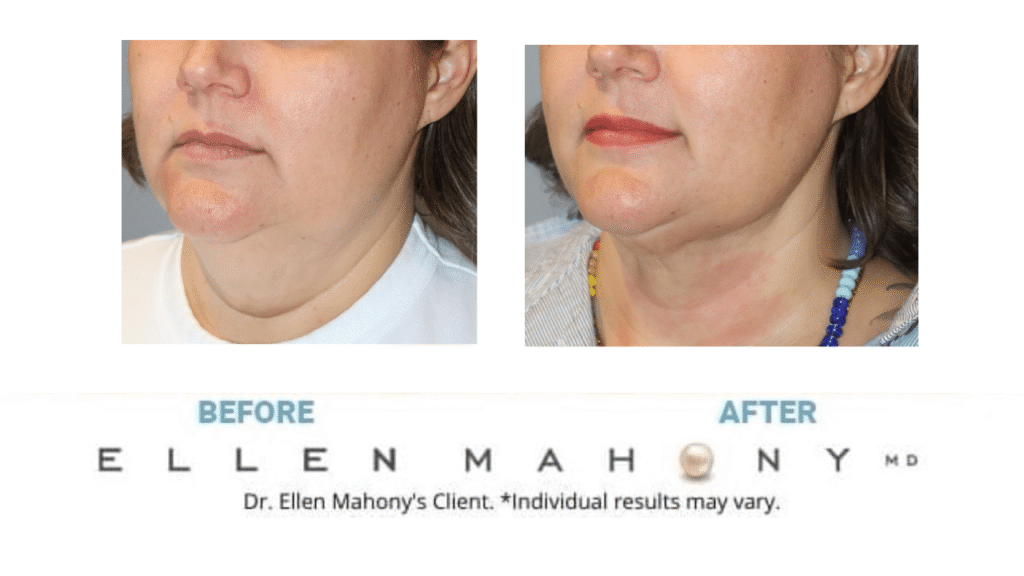 Before and After Image: Case #15237 - left-front-oblique